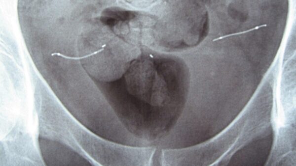 221010 - Splann ! Implant Essure. Image Victimes DMI